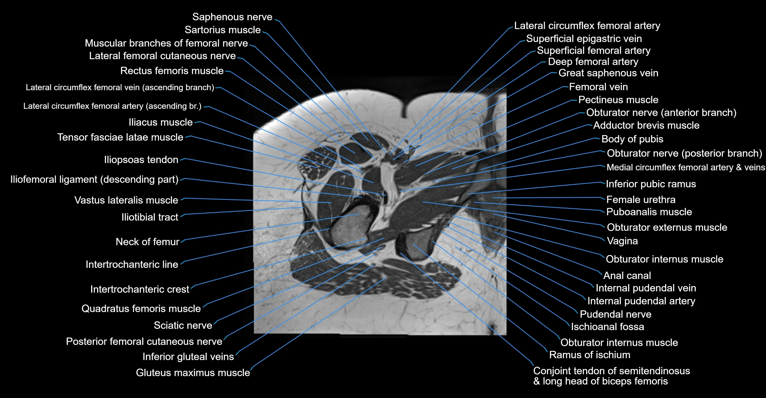 MRI hip axial cross sectional anatomy 3T 3D  radiology  anatomy image-img-00001-00058.webp